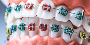 light blue braces
