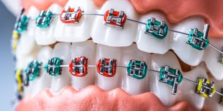light blue braces