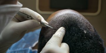 The pros and cons of FUT vs FUE (Follicular Unit Extraction) hair transplant methods:
